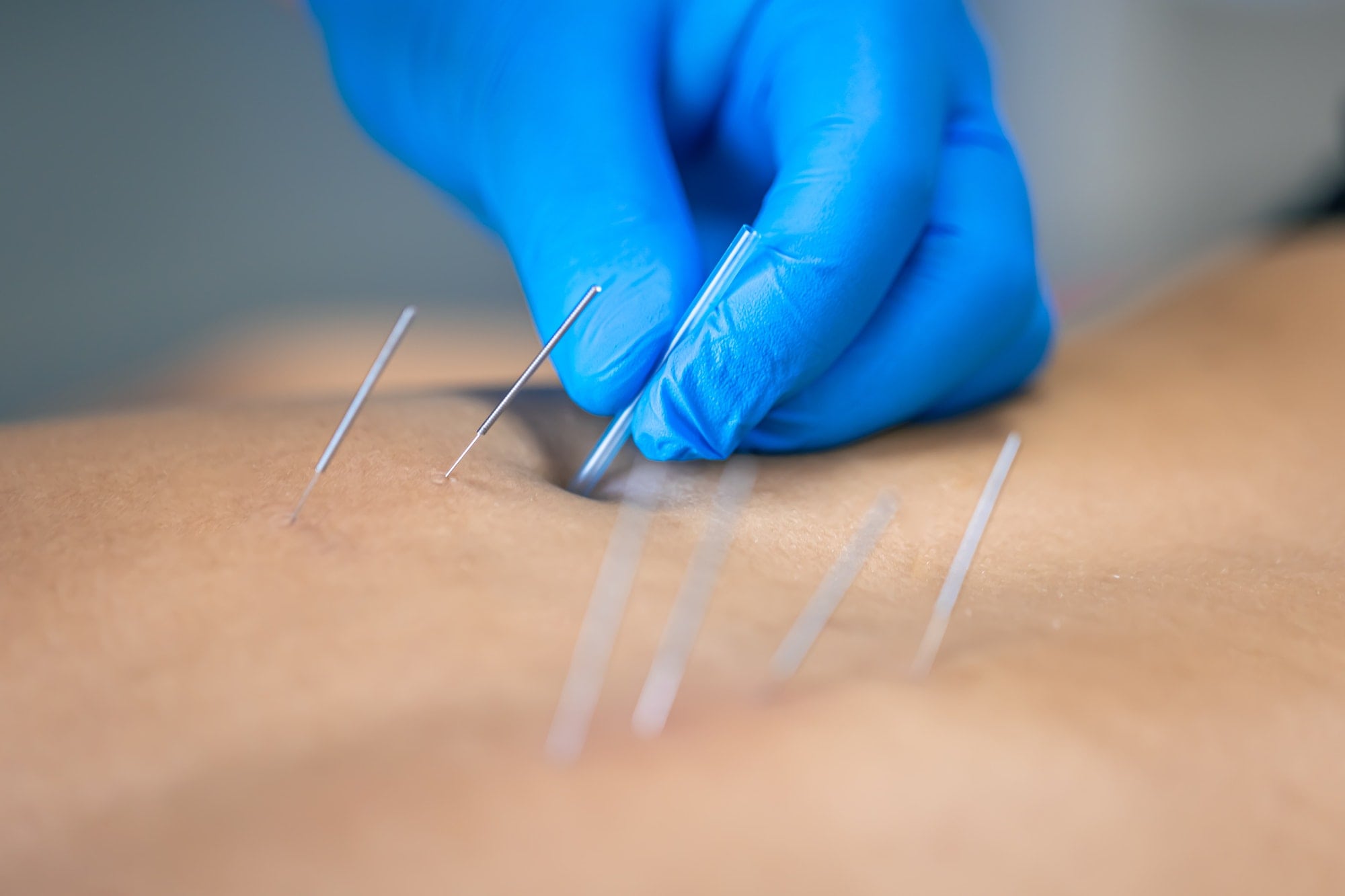 Close up of a needle and hands of physiotherapist doing a dry needling.